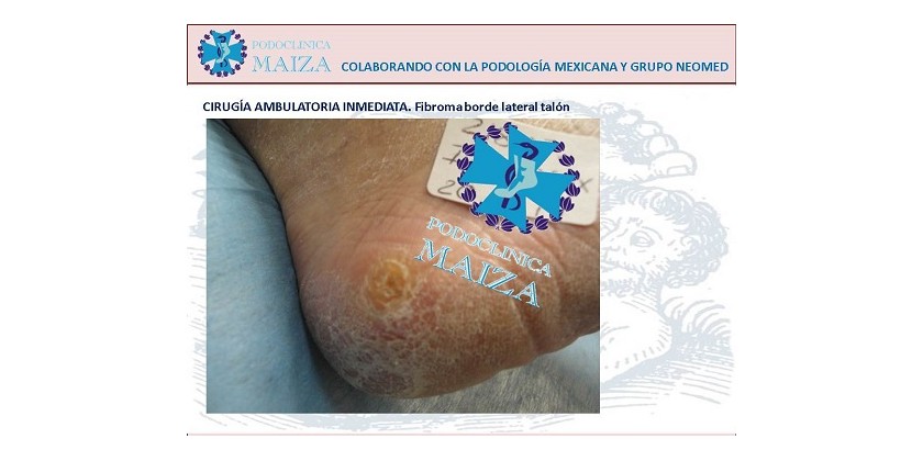 CIRUGÍA AMBULATORIA INMEDIATA DE FIBROMA